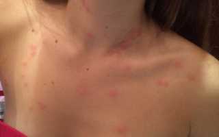 Красное пятно на груди у женщин: причины воспаления и зуда кожи