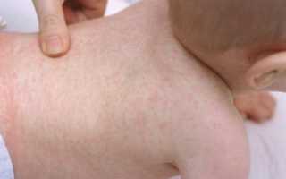 Сыпь на животе и спине у ребенка: что делать, если появились высыпания на теле