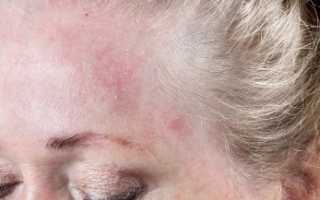 Аллергия на лбу: что делать, когда появились красные пятна и сыпь на коже
