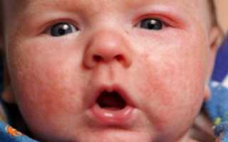 Диатез на щеках у ребенка: чем лечить, что делать, фото