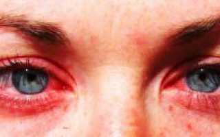 Аллергия на йод и препараты йода: как проявляется, как определить, как проверить реакцию на коже