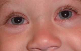Аллергический ринит у ребенка: симптомы и лечение насморка