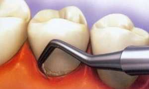 Накопление зубного камня: причины, нужно ли удалять, способы чистки