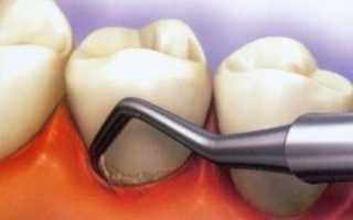 Накопление зубного камня: причины, нужно ли удалять, способы чистки