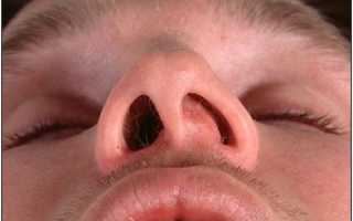 Причины возникновения боли в носу
