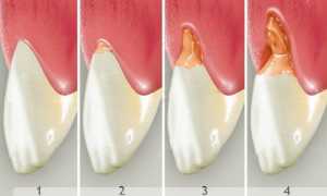 Клиновидный дефект зубов: причины и лечение, фото, МКБ-10, цена лечения