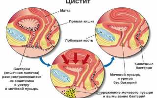 Объясняется ли цистит психосоматикой?