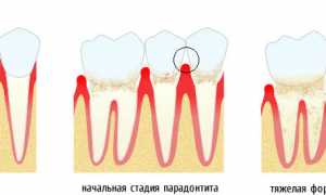 Пародонтит: фото, симптомы, лечение десен, эффективные препараты