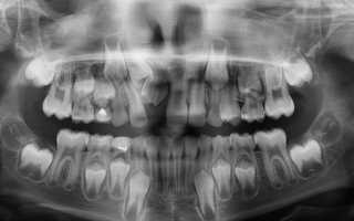 Полиодонтия (гипердонтия) зубов: нужна ли операция?
