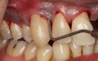 Пародонтоз: как спасти зубы? Симптомы, лечение, лекарства, фото