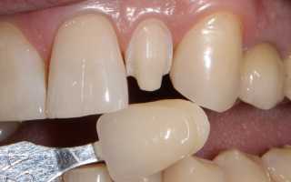 Виниры на зубы (съемные, керамические, композитные, люминиры): цена, отзывы, что это такое и где купить