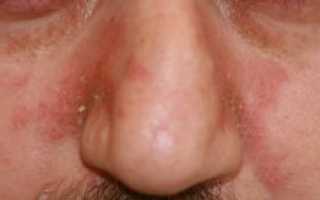 Себорейный дерматит на лице: фото, лечение, симптомы