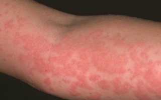 Красные пятна на теле: причины и лечение бляшек на коже