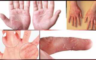 Аллергия на латекс: как проявляется реакция на перчатки у женщин, на презервативы у мужчин, на соску у детей