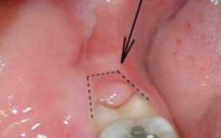 Перикоронит (перикоронарит) зуба мудрости: лечение, МКБ-10