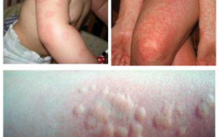 Аллергия на ольху: фото, как проявляется и чем лечить симптомы у детей и взрослых