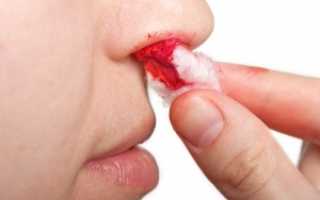 Как можно быстро и эффективно остановить носовое кровотечение