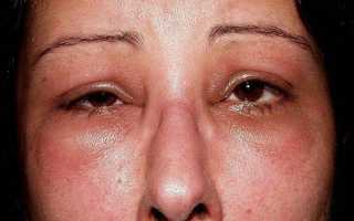 Аллергический отёк лица: что делать, когда от аллергии опухло лицо