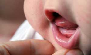 Молочные зубы у детей: порядок прорезывания, кариес, пульпит, удаление