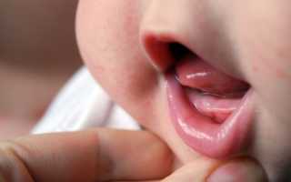 Молочные зубы у детей: порядок прорезывания, кариес, пульпит, удаление