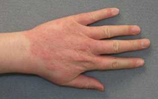Аллергия на ладонях и кистях рук: фото, причины, лечение у детей и взрослых