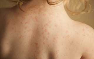 Аллергия на антибиотики: что делать, если появилась сыпь на коже