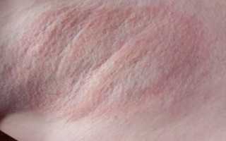Красные пятна под мышками: причины раздражения кожи у детей и взрослых
