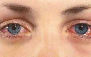 Аллергия на тушь для ресниц: фото и симптомы реакции