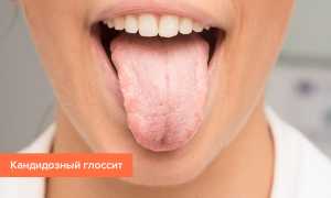 Глоссит языка: фото, лечение, симптомы