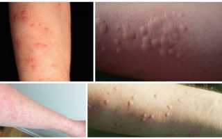 Что делать когда появилась аллергия на руках в виде красных пятен или пузырьков