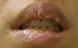 Аллергия на губах: причины, симптомы, лечение хейлита