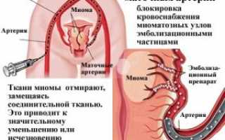 Плюсы и минусы процедуры эмболизации маточных артерий при миоме матки